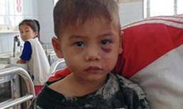 Bé trai ba tuổi bị cha dượng đánh dã man