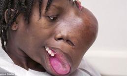 Cô bé có khối u khổng lồ, nặng 1,8kg mọc ra từ khoang mũi