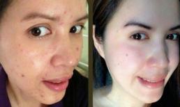 Công nghệ Laser làm trắng da siêu nhanh khuyến mãi 60% 