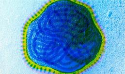 Trị ung thư bằng virus sởi