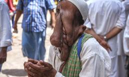 Người đàn ông "mặt quỷ" từ chối phẫu thuật để tiếp tục đi ăn xin