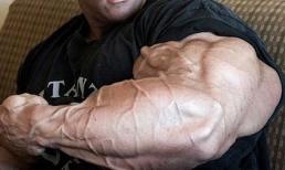 Bắp tay biến dạng kinh hoàng do lạm dụng steroid