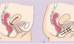 Mắc kẹt khi "yêu", lời đồn hay sự thật?