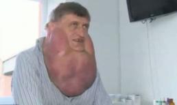 Kinh hoàng khối u nặng gần 6kg "đeo" trên mặt hơn một thập kỷ