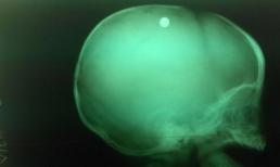 Chị gái nghịch súng, bé trai 6 tháng tuổi bị bắn vào đầu