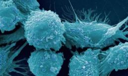 Phát hiện về cách phòng ngừa ung thư ung thư tuyến tiền liệt ở nam giới