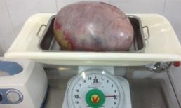 Thiếu nữ bị khối u buồng trứng gần 5kg