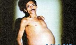 "Mang thai" anh em song sinh 36 năm