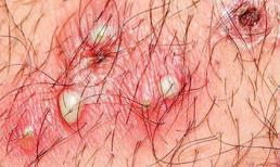 Giải pháp "vàng" trị viêm nang lông 