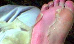 Phát hoảng với mặt nạ da chân gây tê buốt
