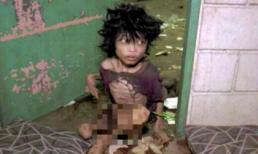 Bị mẹ ruột bỏ đói, bé 15 tuổi suy dinh dưỡng đến mức không thể đi đứng