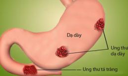 6 điều quan trọng về viêm loét dạ dày ai cũng cần biết