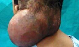 Cắt khối u khổng lồ cho người 'hai đầu'