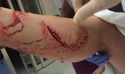 Cô gái trẻ may mắn sống sót sau khi bị cá mập ngoạm vào chân