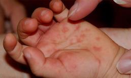 Các bệnh lây nhiễm mùa hè cần chú ý và phòng tránh