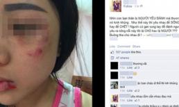 Choáng với thiếu nữ Hà Nội bị người yêu đánh biến dạng gương mặt