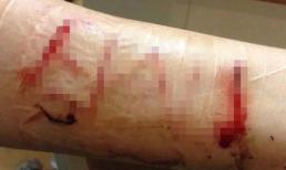 Hoảng hồn với cánh tay chằng chịt vết rạch của cô nàng đồng tính