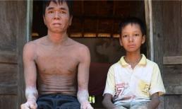 Cận cảnh hai cha con... người rắn ở Quảng Nam