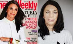 Bị bỏng toàn thân, cụt ngón tay vẫn được mời làm mẫu bìa tạp chí