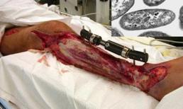 Hãi hùng hình ảnh cắt bỏ chân tay, da mặt vì vi khuẩn ăn thịt người