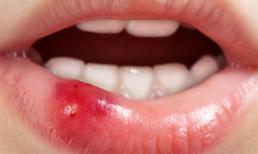 Kỹ năng sơ cứu khi bé bị thương ở miệng