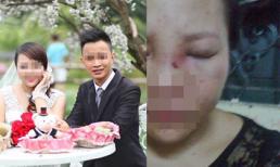 Lộ ảnh mặt sưng tím của cô gái bị chồng chưa cưới đánh và khoe trên Facebook