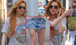 Lindsay Lohan ra đường với đôi chân thâm tím, lồi lõm