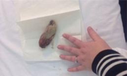 Một sản phụ gốc Việt bị bác sĩ bỏ quên gạc phẫu thuật trong cơ thể