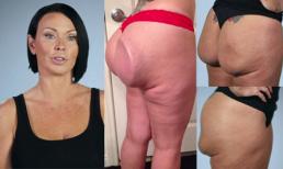 Người phụ nữ bỗng nổi tiếng vì khoe mông độn bị hỏng