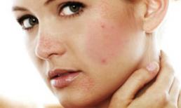 Dấu hiệu đơn giản nhất để nhận biết ngay bệnh ung thư da