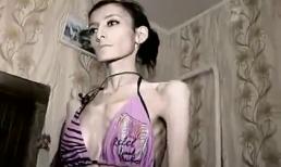 Choáng với thiếu nữ 23 tuổi nặng... 21 kg