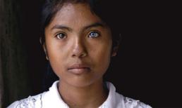 Cô gái có đôi mắt hai màu kỳ lạ ở Ninh Thuận