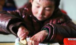 Mắc bệnh lạ, làn da cậu bé không ngừng bong tróc