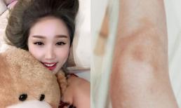 Bảo Thy kiêng vận động mạnh vì bị chấn thương đầu gối