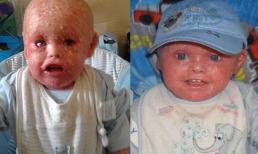 Cậu bé đáng thương bị bạn bè xa lánh vì mắc bệnh 'vảy cá' 