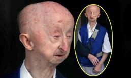 Phẫn nộ người đàn ông tàn tật nhỏ như đứa trẻ vẫn bị tấn công 