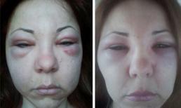 Nữ luật sư mặt sưng như quả bóng sau khi tiêm căng da