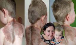 Cậu bé có vết bớt trên lưng như đôi cánh thiên thần