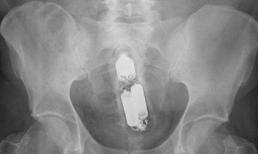 Tá hỏa phát hiện đồ vật trong cơ thể qua X-quang