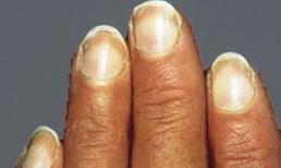 14 dấu hiệu ở móng tay cảnh báo bạn đang bị bệnh