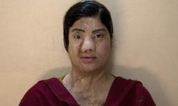 Khoe được làm tiếp viên hàng không, cô gái bị bạn ghen ghét tạt axit