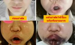 Cô gái thẩm mỹ khiến mặt sưng vù biến dạng 