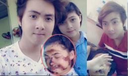 Chuyện tình xúc động của chàng trai chung thủy với bạn gái bị hủy hoại khuôn mặt
