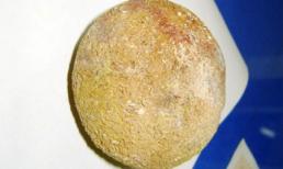 Viên sỏi thận to như quả cam