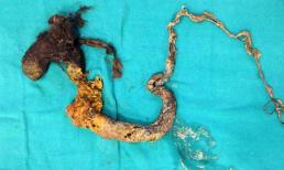 Phát hiện búi tóc lớn trong dạ dày cậu bé 4 tuổi