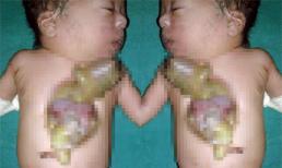 Bé sơ sinh có tim ngoài lồng ngực