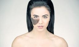 Cô gái có vết chàm kiên quyết không phẫu thuật thẩm mỹ