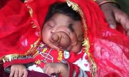 Bé gái vừa sinh ra đã có 'vòi voi' ngay trên mặt