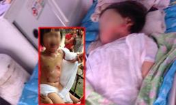 Xót xa bé gái bị bạn đốt bỏng nửa người ở trường mầm non
