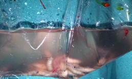 Hiếm gặp: Giòi sống lúc nhúc trên đầu bệnh nhân